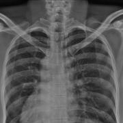 Situs inversus Situs inversus